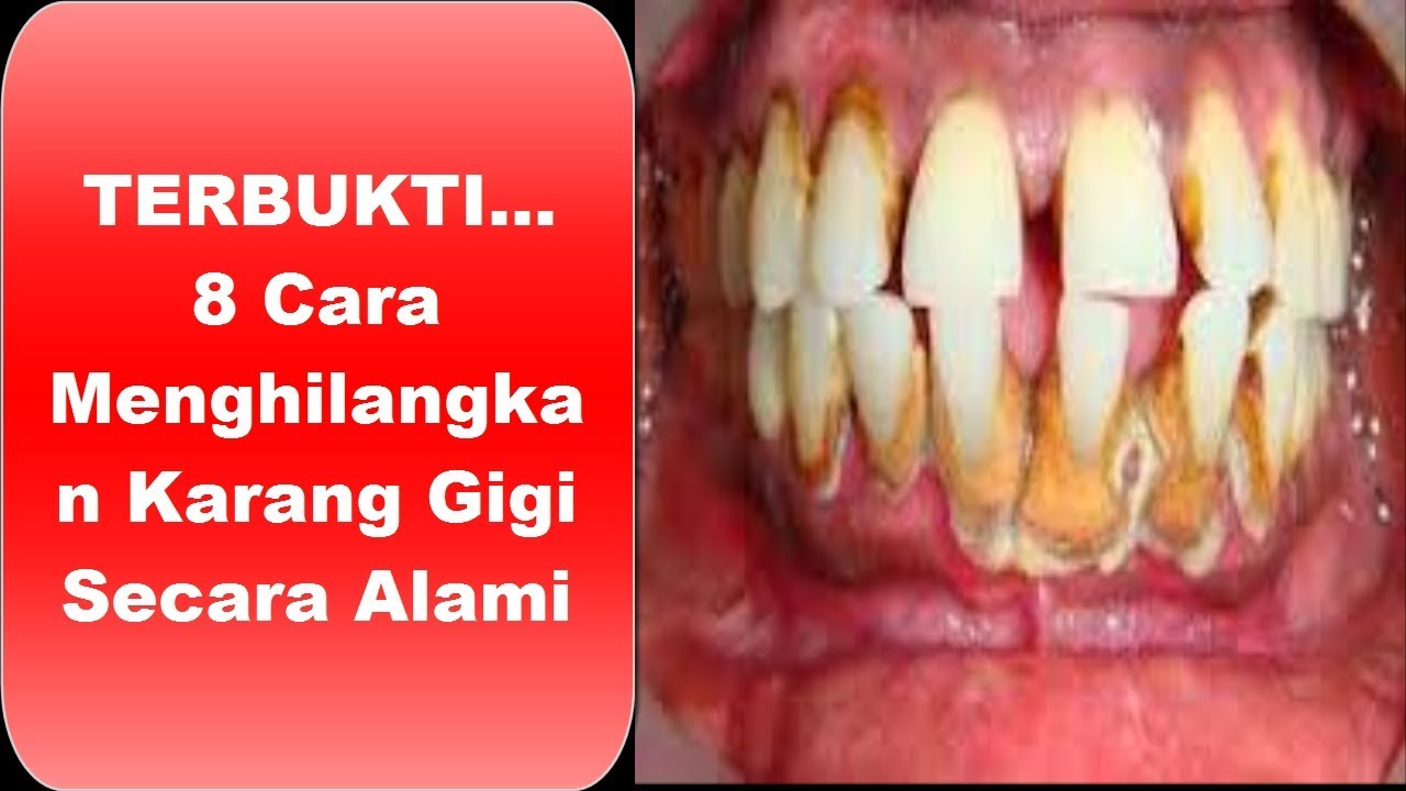 TERBUKTI..8 Cara Menghilangkan Karang Gigi Secara Alami YouTube