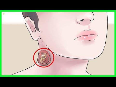  Effective Natural Remedies To Cure Sebaceous Cysts | Best Home Remedies