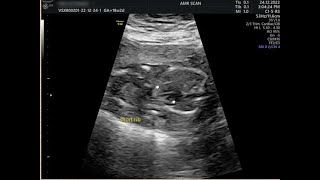case of the week 8 short rib thoracic dysplasia mainzer  saldino syndrome
