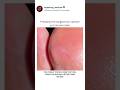 🩺Probably the longest hair splinter you’ve ever seen 😷#trending #pharmcist #doctorlife #viral
