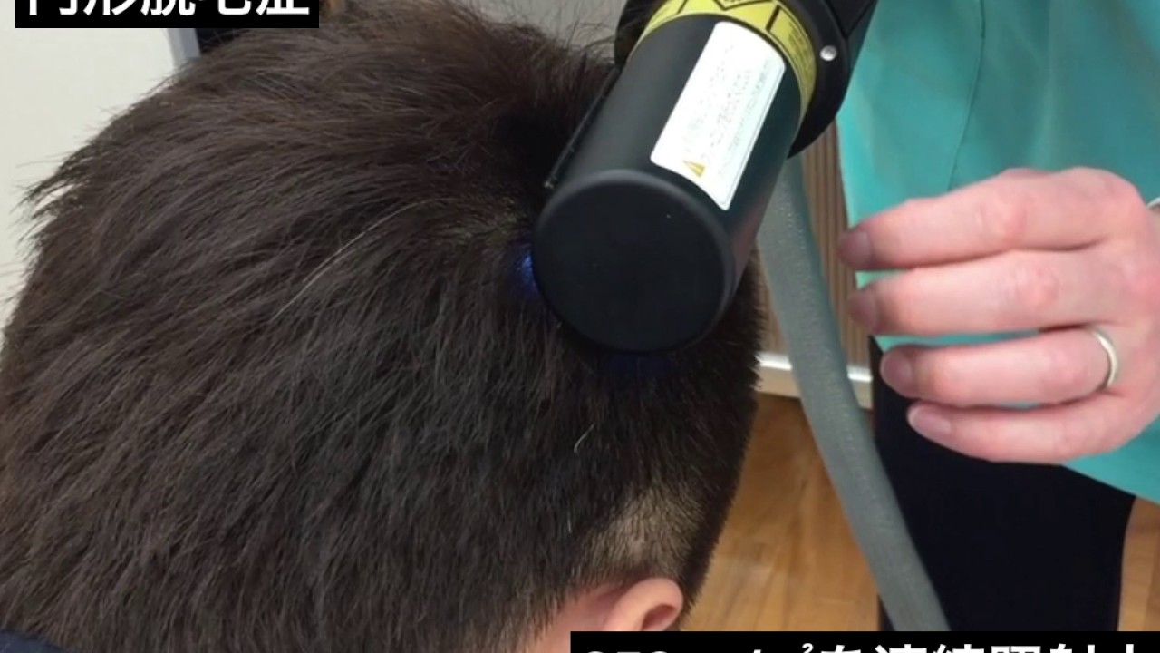 えぬくりブログ 円形脱毛症