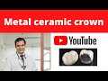 METAL CERAMIC CAP///HINDI— DENTAL CAP DESCRIPTION