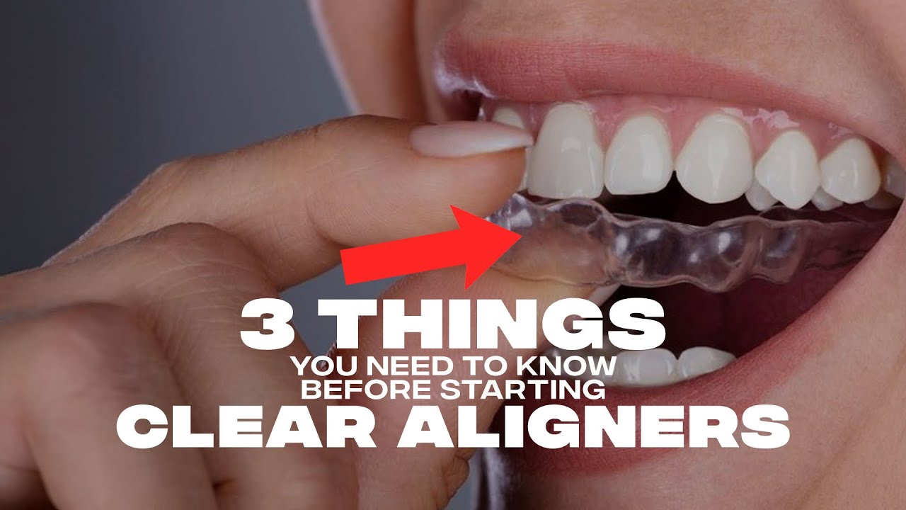 Three Things You Need To Know Before Starting Clear Aligners - YouTube