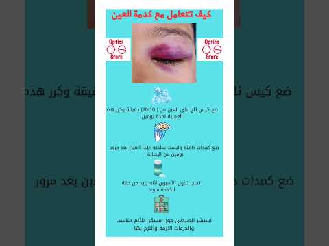 التعامل مع كدمة العين كدمات الشعب الصيني ماله حل العين عناية