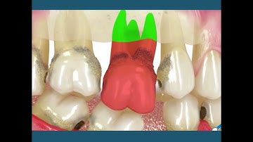 Hậu Quả Mất Răng Lâu Năm