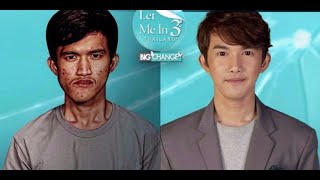 Thai man undergoes dramatic transformation with plastic surgery in South Korea