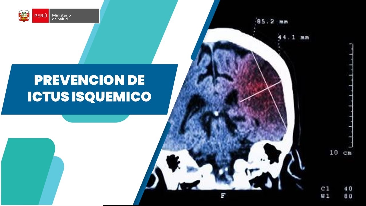 PREVENCION DE ICTUS ISQUEMICO