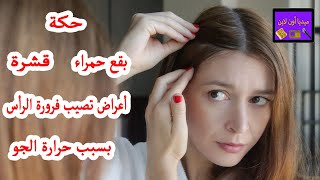 حكة وبقع حمراء وقشرة .. أعراض تصيب فرورة الرأس بسبب حرارة الجو تعرف على التفاصيل