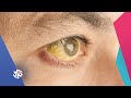 التهاب الكبد الفيروسي الأسباب والعوارض والعلاج صباح النور