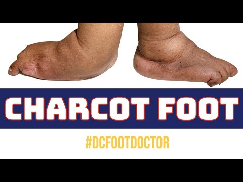 Video: Charcot Foot: Vzroki, Simptomi In Zdravljenje