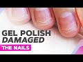 Badly Damaged Nails | Gel Polish Allergy, Nail Plate Burn, Onycholysis