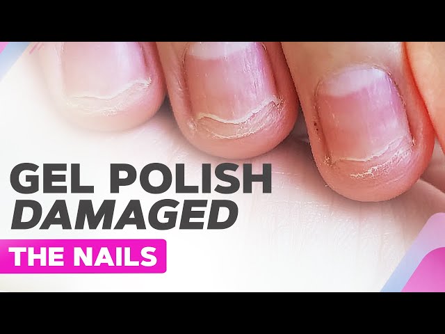 More About Nail Bed Injury: What to do when they happen and prognosis