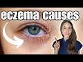 Causes And Treatment Of Eyelid Eczema Explained
