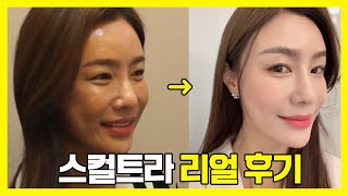 10살 어려지게 해주는 스컬트라 리얼 후기
