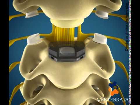 Vídeo: Comparação Biomecânica De Artroplastia De Disco Cervical Não Contígua E Discectomia Cervical Não-contígua E Fusão No Tratamento De Doença Degenerativa Do Disco Cervical Não-contínu