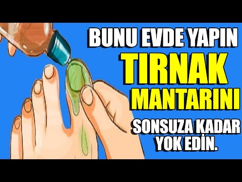 Video: Çürük Ayak Tırnağını Hızla İyileştirmenin 4 Basit Yolu