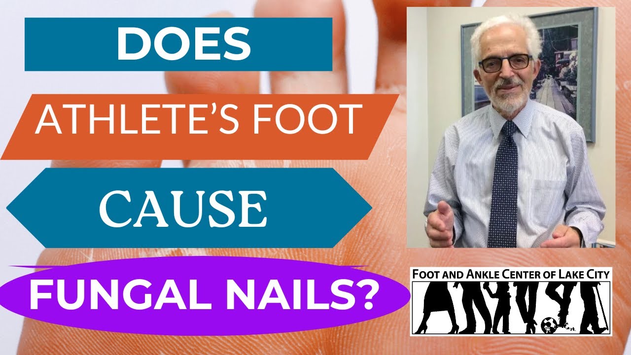 Does Athlete's Foot Cause Fungal Toenails? YouTube
