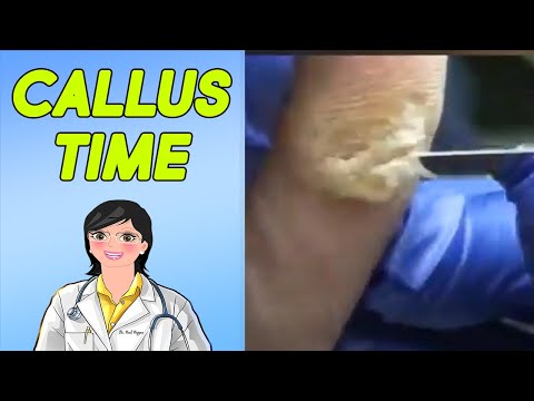 Nails, Calluses, Tunes! Trim Them Down!
