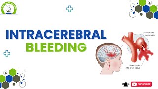 Intracerebral Bleeding - Breaking Bad News | PLAB GUIDE ACADEMY