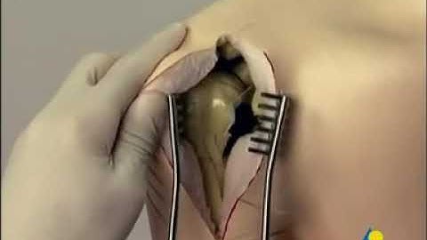 AO humerus proximal fixation with PHILOS plate