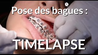 Pose d'un appareil dentaire : Timelapse - Appareil-dentaire.info screenshot 1