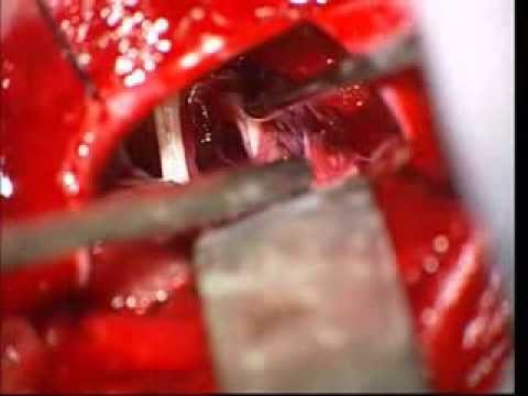 Review Facial Pain Trigeminal Neuralgia