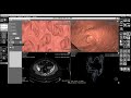 Обучающее видео к программе “Виртуальная колоноскопия”