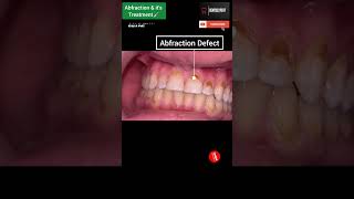 Restoration Of Abfracted Teeth Veneering Of Abfracted Teeth