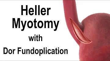 Heller Myotomy with Dor Fundoplication Animation for the Treatment of Achalasia