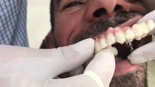 زراعة اسنان كامله للفك العلوي مع التركيب من مادة البورسلان