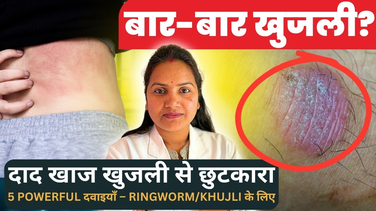 Fungal Infection का जड़ से इलाज | Ringworm, Itching, Rashes? - YouTube