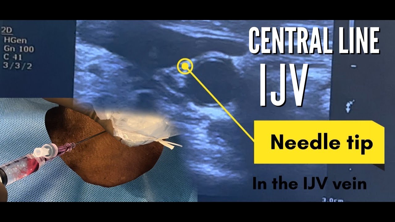Center Line Insertion Ultrasound Guided Central Line Insertion | IJV Central line | IV Line ...