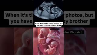 Twin Pregnancy on Ultrasound Scan in Second Trimester
