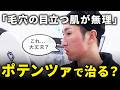 【昼におはよう】学生時代潰して後悔…ニキビ痕、毛穴の広がりを撲滅したい!治療とダウンタイムの様子に密着!【ポテンツァ/イオン導入/ハイドラジェントル】