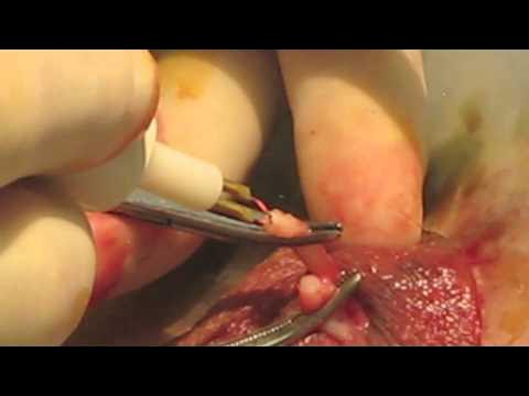 Vasectomy - YouTube