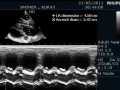 LARGE PERICARDIAL EFFUSION - ECHOCARDIOGRAPHY SERIES BY DR.ANKUR.K.CHAUDHARI