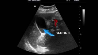 EMERGENCY ULTRASOUND IN RIGHT UPPER QUADRANT PAIN; CASE 1