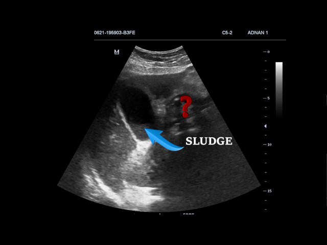 EMERGENCY ULTRASOUND IN RIGHT UPPER QUADRANT PAIN; CASE 1 class=