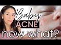 Newborn Baby Acne EASY FIX! #newborn #baby