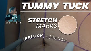 Tummy Tuck: Incisions and Stretch Marks