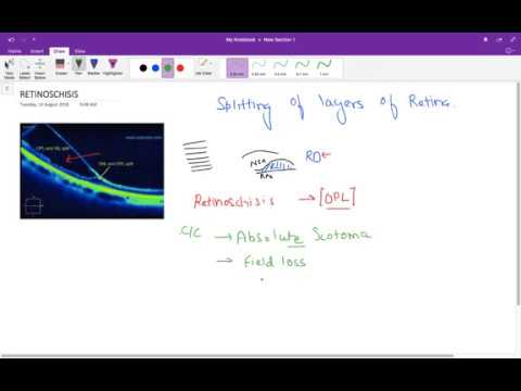 Video: Perifer Nethinden Neovaskularisering Sekundær Til Stærkt Myopisk Overfladisk Retinoschisis: En Sagsrapport