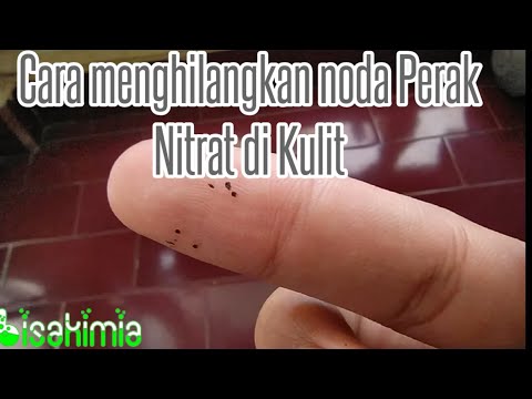 Menghilangkan Noda Perak Nitrat AgNO3 di Kulit