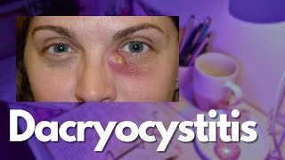 Dacryocystitis - Ophthalmology Notes