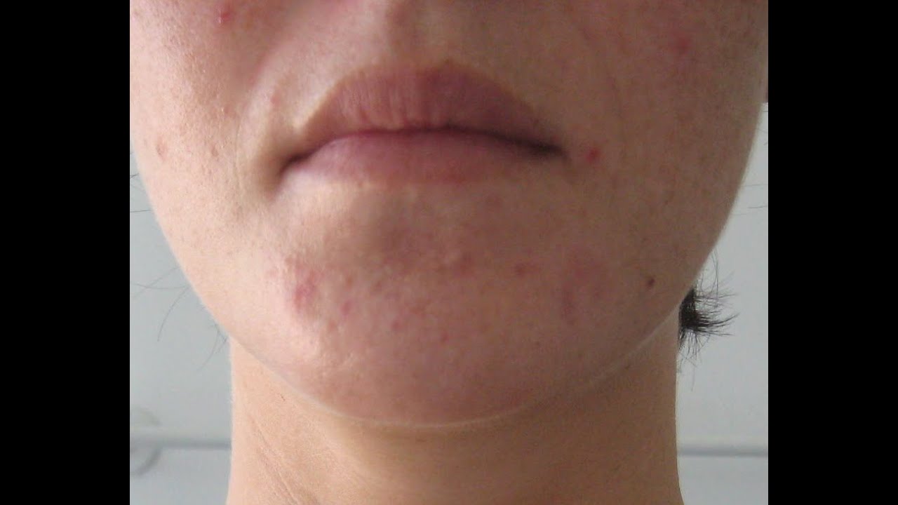 Bumps on facial skin - Adult videos. 