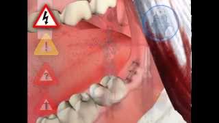 Live Operation How The Wisdom Tooth Is Removed