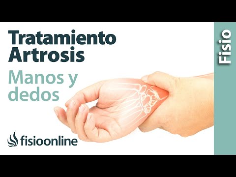 Vídeo: Osteoartritis De Las Manos