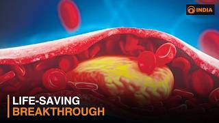 Doctors Achieve Breakthrough in Cholesterol Treatment Using LDL Apheresis