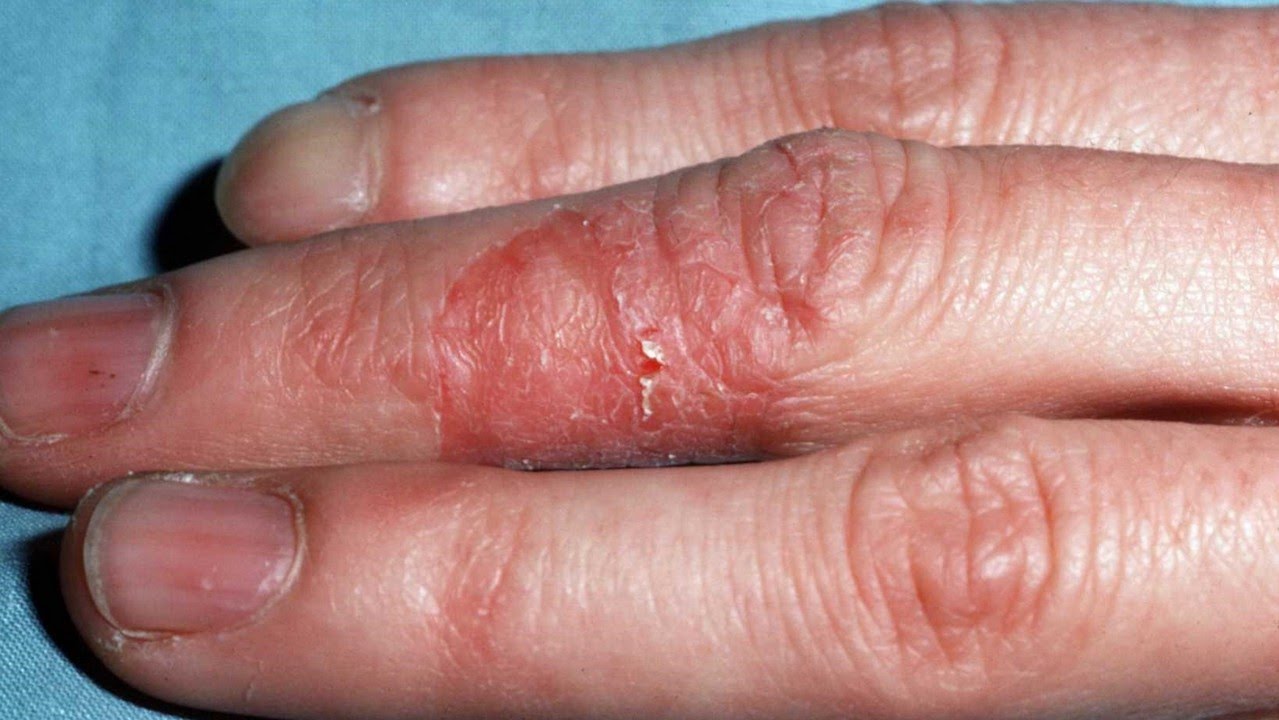 Dermatitis herpetiformis - Wikipedia