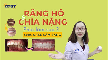 CASE LÂM SÀNG RĂNG HÔ CÓ CĂMS VIS