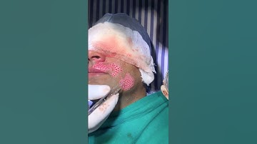 Punch Grafting Surgery in Vitiligo | vitiligo | punch grafting | Skinaa Clinic #shortviral